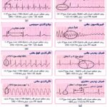 عکس نوار قلب نامنظم -تصویر سوم