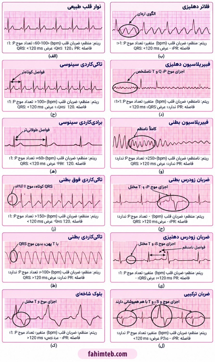 عکس نوار قلب نامنظم -تصویر سوم