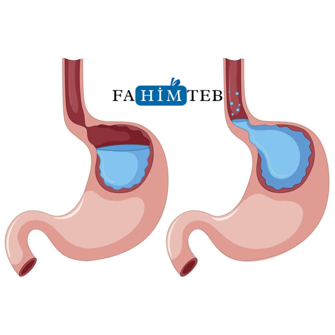 رفلاکس معده و ارتباط آن با معده درد - فهیم طب