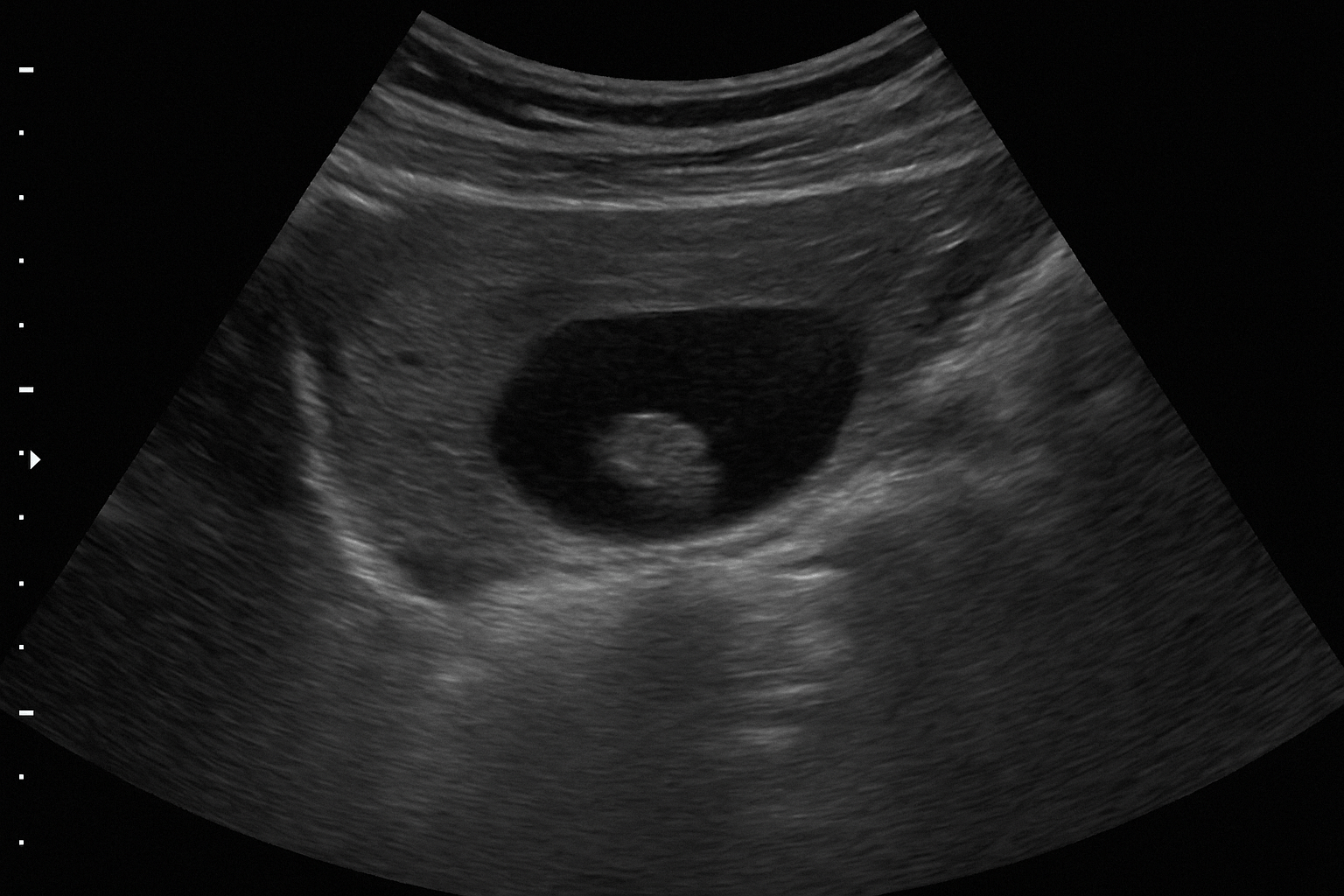 شن کلیه چیست؟ علل، ۵ علامت مهم، و روش های درمان 2 سونوگرافی از شن کلیه