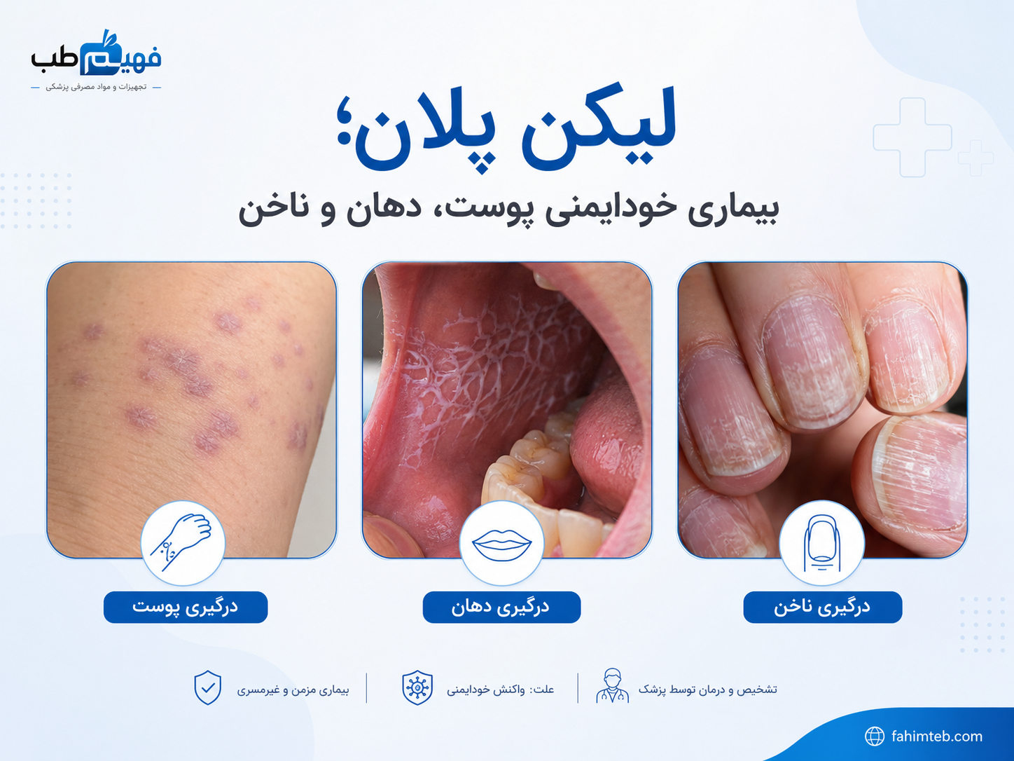 لیکن پلان؛ بیماری خودایمنی پوست، دهان و ناخن
