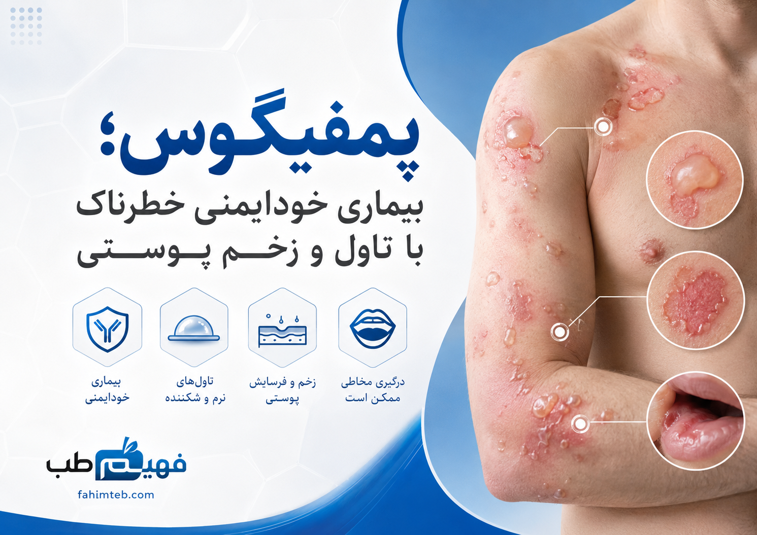 پمفیگوس؛ بیماری خودایمنی خطرناک با تاول و زخم پوستی
