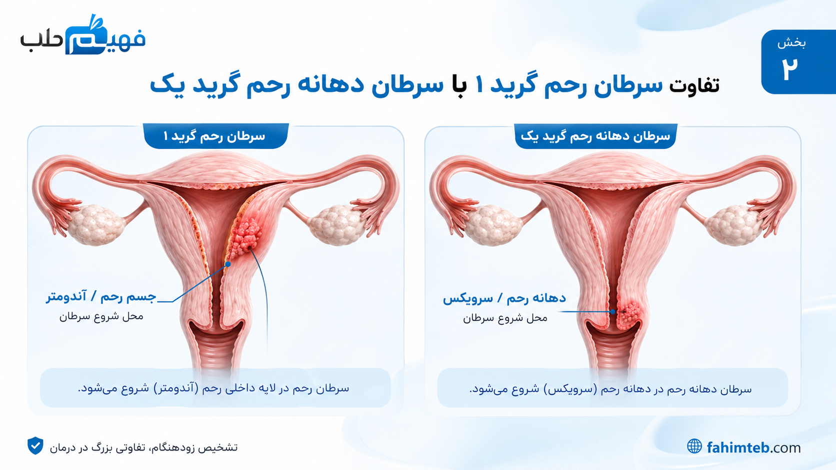 تفاوت سرطان رحم گرید ۱ با سرطان دهانه رحم گرید یک