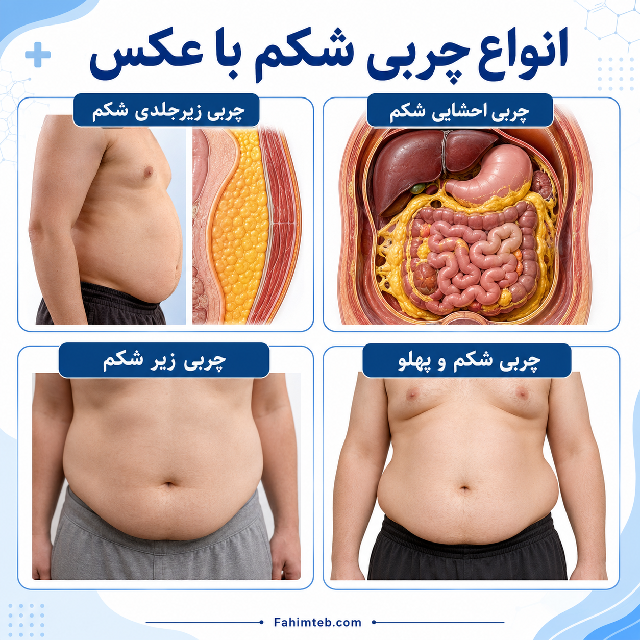 انواع چاقی شکم از نظر پزشکی | علائم، علت و ارزیابی 10 عکس انواع چربی شکم