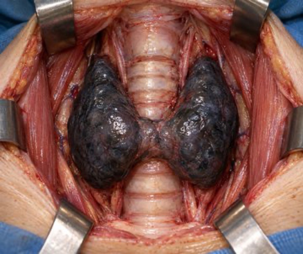 ‏تیروئید سیاه (Black Thyroid Gland)